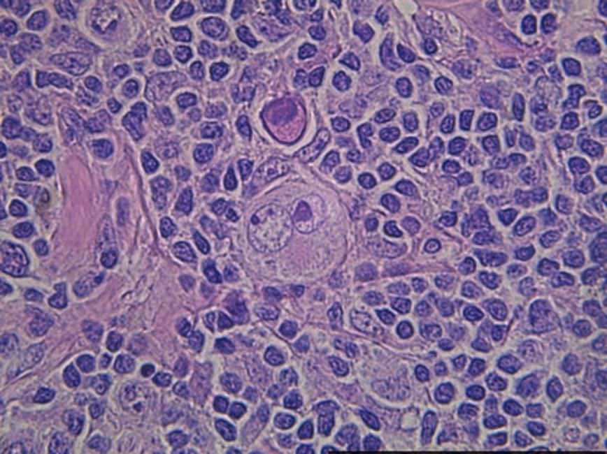 The Josep Carreras Leukaemia Research Institute identifies a marker of poor evolution in Hodgkin's lymphoma